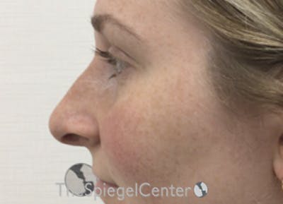 Non-Surgical Rhinoplasty / Nose Filler Before & After Gallery - Patient 351463 - Image 3