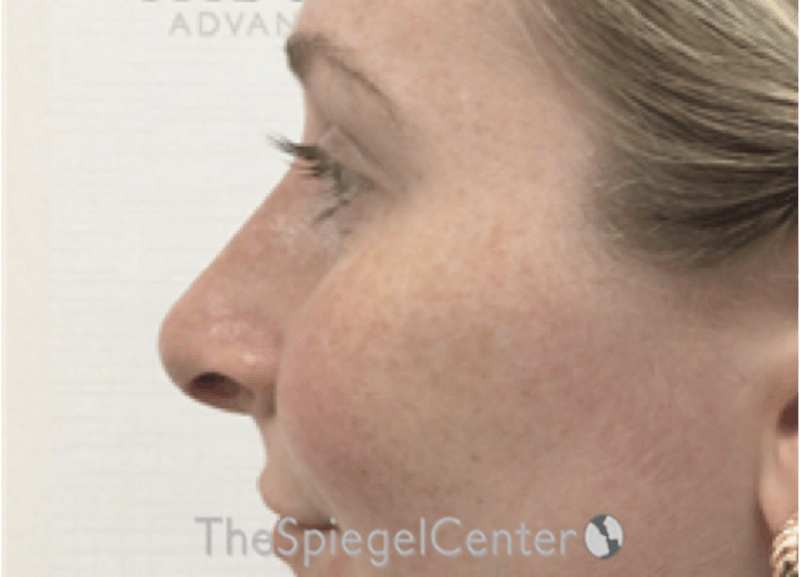 Non-Surgical Rhinoplasty / Nose Filler Before & After Gallery - Patient 351463 - Image 4