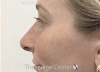 Non-Surgical Rhinoplasty / Nose Filler Before & After Gallery - Patient 351463 - Image 4