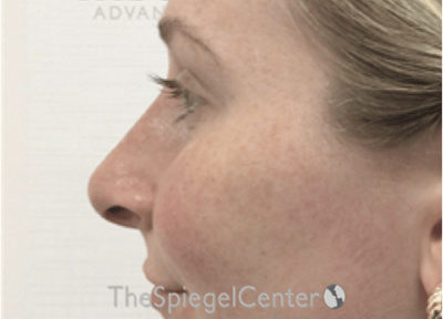 Non-Surgical Rhinoplasty / Nose Filler Before & After Gallery - Patient 351463 - Image 4
