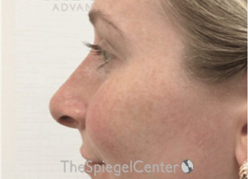 Non-Surgical Rhinoplasty / Nose Filler Before & After Gallery - Patient 351463 - Image 4
