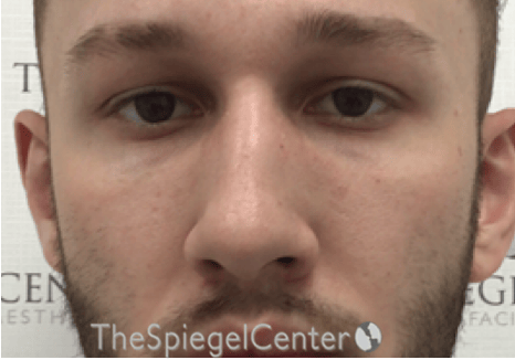 Non-Surgical Rhinoplasty / Nose Filler Before & After Gallery - Patient 139119 - Image 1