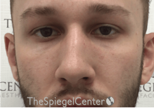Non-Surgical Rhinoplasty / Nose Filler Before & After Gallery - Patient 139119 - Image 1