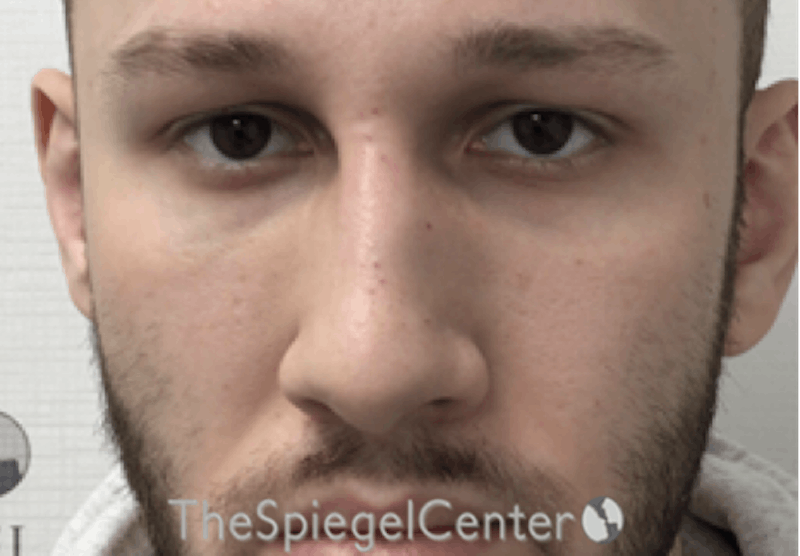 Non-Surgical Rhinoplasty / Nose Filler Before & After Gallery - Patient 139119 - Image 2