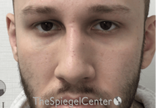 Non-Surgical Rhinoplasty / Nose Filler Before & After Gallery - Patient 139119 - Image 2