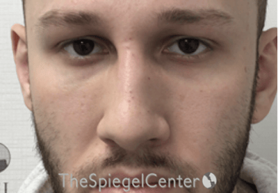 Non-Surgical Rhinoplasty / Nose Filler Before & After Gallery - Patient 139119 - Image 2