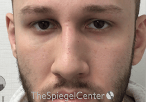 Non-Surgical Rhinoplasty / Nose Filler Before & After Gallery - Patient 139119 - Image 2