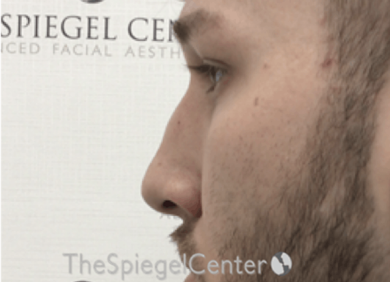 Non-Surgical Rhinoplasty / Nose Filler Before & After Gallery - Patient 139119 - Image 3