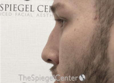 Non-Surgical Rhinoplasty / Nose Filler Before & After Gallery - Patient 139119 - Image 3