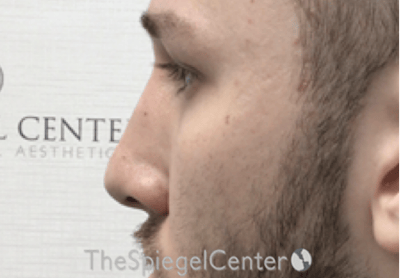 Non-Surgical Rhinoplasty / Nose Filler Before & After Gallery - Patient 139119 - Image 4