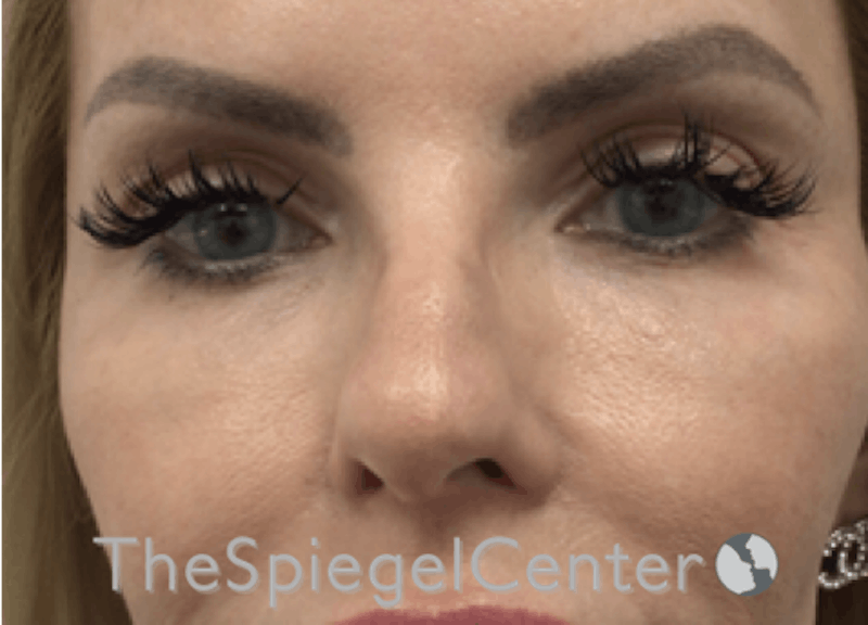 Non-Surgical Rhinoplasty / Nose Filler Before & After Gallery - Patient 150276 - Image 1