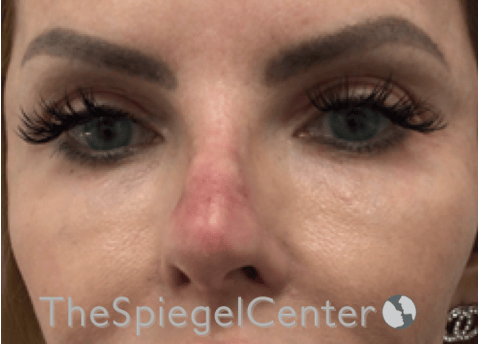 Non-Surgical Rhinoplasty / Nose Filler Before & After Gallery - Patient 150276 - Image 2