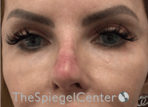 Non-Surgical Rhinoplasty / Nose Filler Before & After Gallery - Patient 150276 - Image 2