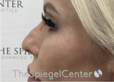 Non-Surgical Rhinoplasty / Nose Filler Before & After Gallery - Patient 150276 - Image 3