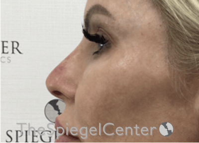 Non-Surgical Rhinoplasty / Nose Filler Before & After Gallery - Patient 150276 - Image 4