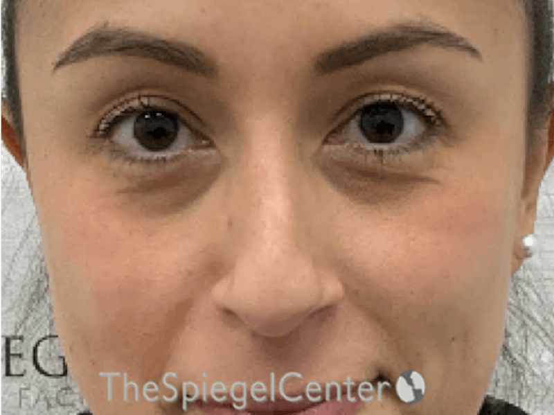 Non-Surgical Rhinoplasty / Nose Filler Before & After Gallery - Patient 281654 - Image 1