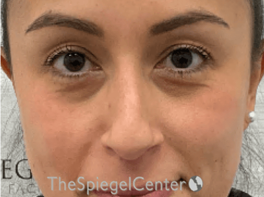 Non-Surgical Rhinoplasty / Nose Filler Before & After Gallery - Patient 281654 - Image 1