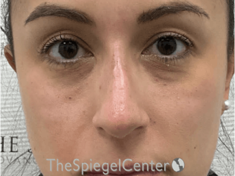 Non-Surgical Rhinoplasty / Nose Filler Before & After Gallery - Patient 281654 - Image 2