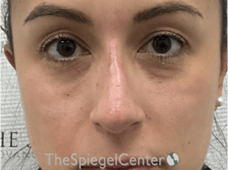 Non-Surgical Rhinoplasty / Nose Filler Before & After Gallery - Patient 281654 - Image 2