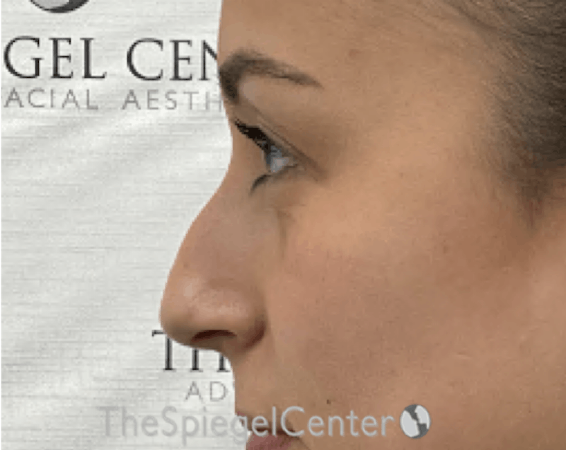 Non-Surgical Rhinoplasty / Nose Filler Before & After Gallery - Patient 281654 - Image 3