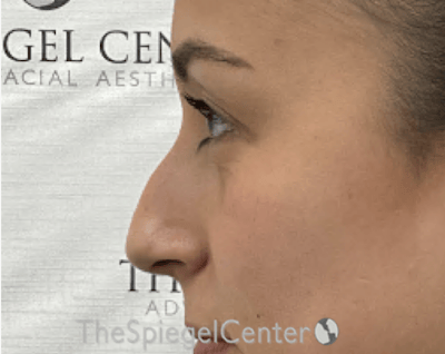 Non-Surgical Rhinoplasty / Nose Filler Before & After Gallery - Patient 281654 - Image 3