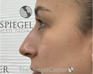 Non-Surgical Rhinoplasty / Nose Filler Before & After Gallery - Patient 281654 - Image 4