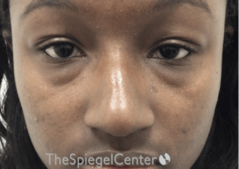 Non-Surgical Rhinoplasty / Nose Filler Before & After Gallery - Patient 422546 - Image 1
