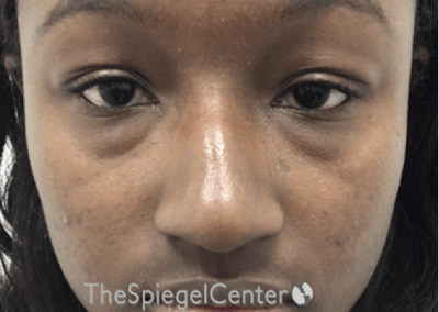 Non-Surgical Rhinoplasty / Nose Filler Before & After Gallery - Patient 422546 - Image 1
