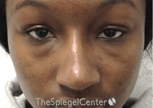 Non-Surgical Rhinoplasty / Nose Filler Before & After Gallery - Patient 422546 - Image 2