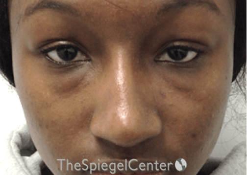 Non-Surgical Rhinoplasty / Nose Filler Before & After Gallery - Patient 422546 - Image 2