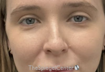 Non-Surgical Rhinoplasty / Nose Filler Before & After Gallery - Patient 203612 - Image 1