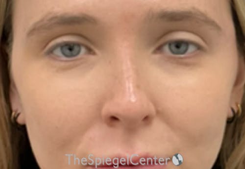 Non-Surgical Rhinoplasty / Nose Filler Before & After Gallery - Patient 203612 - Image 2