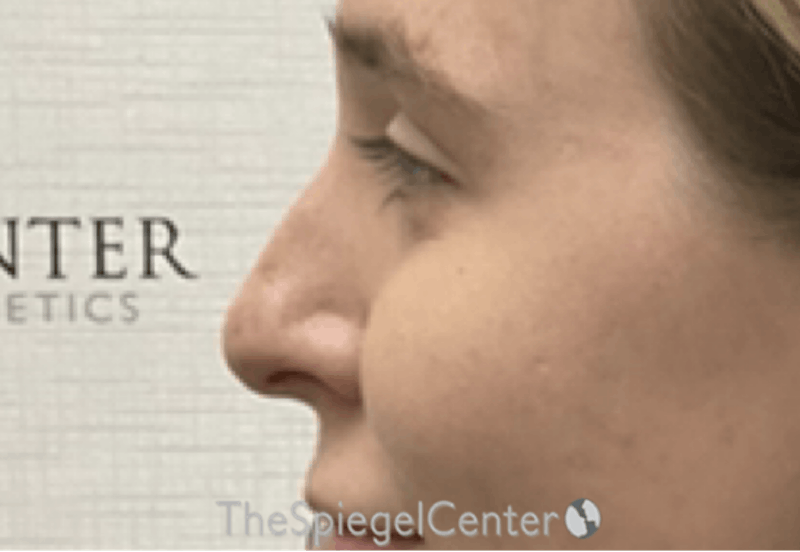 Non-Surgical Rhinoplasty / Nose Filler Before & After Gallery - Patient 203612 - Image 3