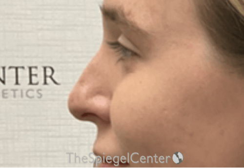 Non-Surgical Rhinoplasty / Nose Filler Before & After Gallery - Patient 203612 - Image 3