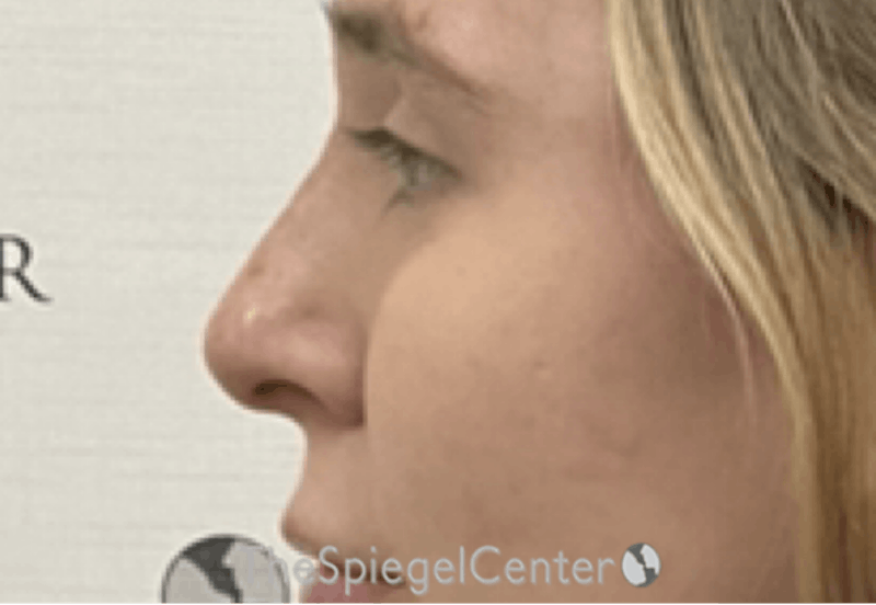 Non-Surgical Rhinoplasty / Nose Filler Before & After Gallery - Patient 203612 - Image 4