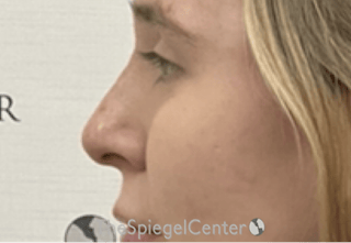 Non-Surgical Rhinoplasty / Nose Filler Before & After Gallery - Patient 203612 - Image 4