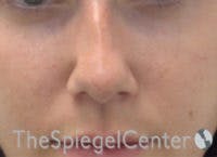 Non-Surgical Rhinoplasty / Nose Filler Before & After Gallery - Patient 377639 - Image 1