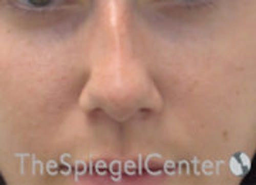 Non-Surgical Rhinoplasty / Nose Filler Before & After Gallery - Patient 377639 - Image 1