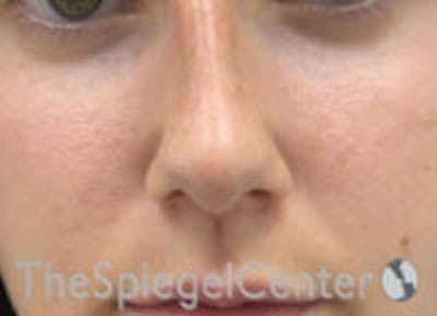 Non-Surgical Rhinoplasty / Nose Filler Before & After Gallery - Patient 377639 - Image 2