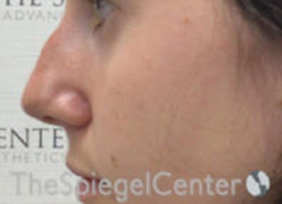 Non-Surgical Rhinoplasty / Nose Filler Before & After Gallery - Patient 377639 - Image 3