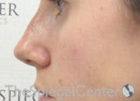 Non-Surgical Rhinoplasty / Nose Filler Before & After Gallery - Patient 377639 - Image 4