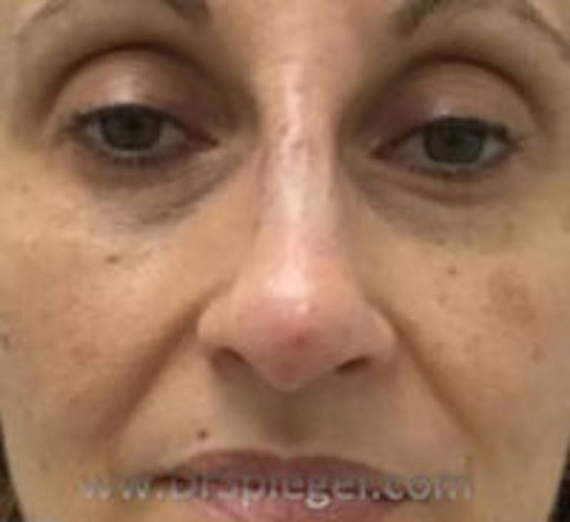 Non-Surgical Rhinoplasty / Nose Filler Before & After Gallery - Patient 218192 - Image 2