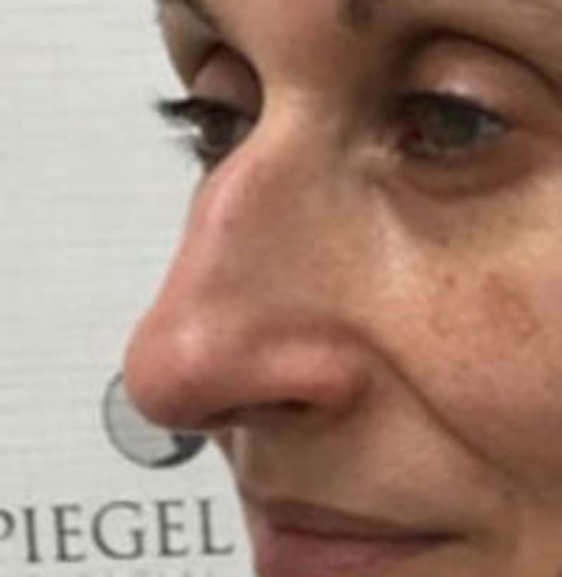 Non-Surgical Rhinoplasty / Nose Filler Before & After Gallery - Patient 218192 - Image 3