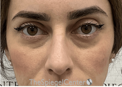 Non-Surgical Rhinoplasty / Nose Filler Before & After Gallery - Patient 305227 - Image 1