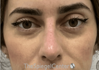 Non-Surgical Rhinoplasty / Nose Filler Before & After Gallery - Patient 305227 - Image 2