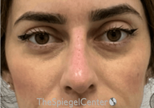 Non-Surgical Rhinoplasty / Nose Filler Before & After Gallery - Patient 305227 - Image 2