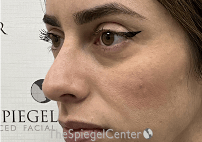 Non-Surgical Rhinoplasty / Nose Filler Before & After Gallery - Patient 305227 - Image 3