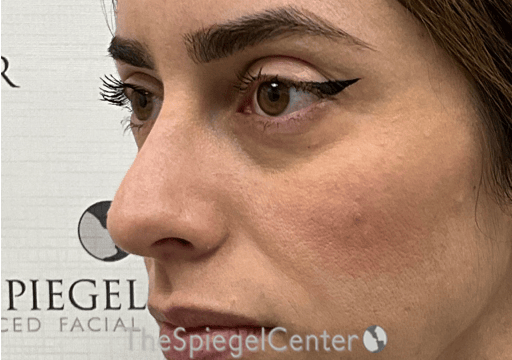 Non-Surgical Rhinoplasty / Nose Filler Before & After Gallery - Patient 305227 - Image 3