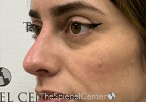 Non-Surgical Rhinoplasty / Nose Filler Before & After Gallery - Patient 305227 - Image 4