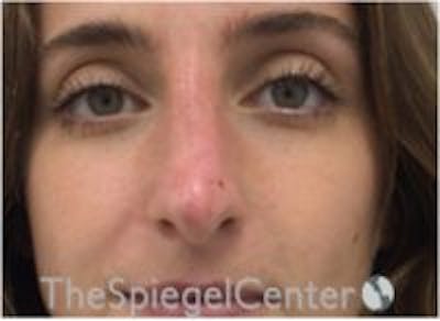 Non-Surgical Rhinoplasty / Nose Filler Before & After Gallery - Patient 283814 - Image 2